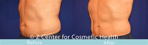 Coolsculpting Abdomen Before & After #31 - Zcosmetic Health