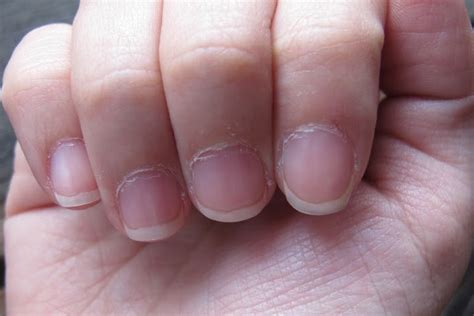 Dry Cuticles- Know The Causes, Home Remedies And Prevention