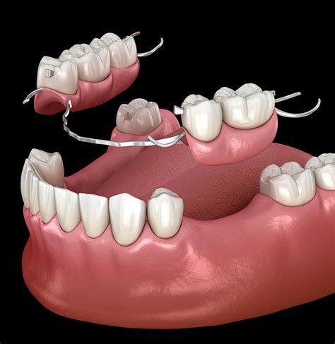 Missing Teeth Barton City, MI | Dental Implants | Dentures