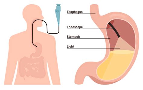 Endoscopy (upper GI) AGA GI Patient Center, 47% OFF