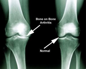 What Is Arthritis? - Larson Sports and Orthopaedics