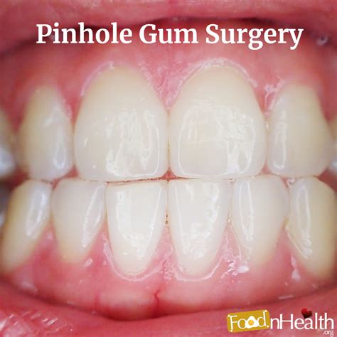 Pinhole Gum Surgery: The Newest Innovative Technique for Gums - Food N Health