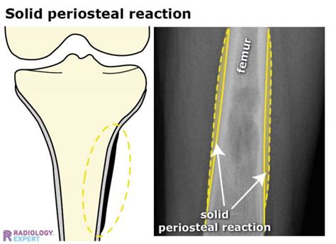 Bone tumours