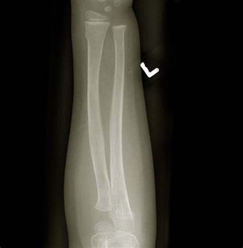 Greenstick Fracture - Pictures, Treatment, Symptoms, Healing Time, Causes | HubPages