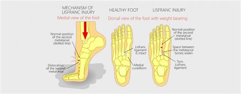 Lisfranc Injuries - Footcare Friday: Alpine Orthopedics and Sports Medicine: Orthopedic Surgery