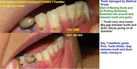 Can you really Re-Grow/ReMineralize your Teeth and Gums? My Oil Pulling Experiment with Photo ...