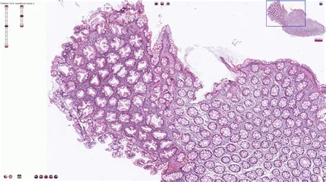 Hyperplastic Polyp Colon