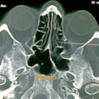 (PDF) Recent advances in Otolaryngology