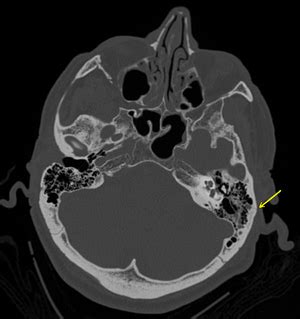 Basilar skull fracture - Wikipedia