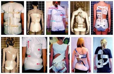 Scoliosis Brace Types, Effectiveness & Disadvantages