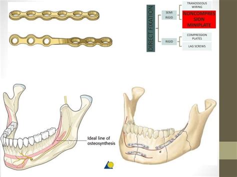 MANAGEMENT OF MAXILLOFACIAL FRACTURES