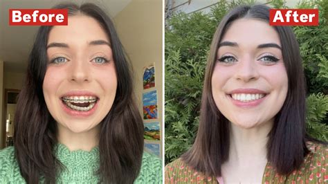 Woman Explains How Her Entire Jaw Was Replaced After a Shocking ...