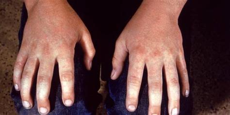 Four rash patterns common in adults with parvovirus infection | 2 ...