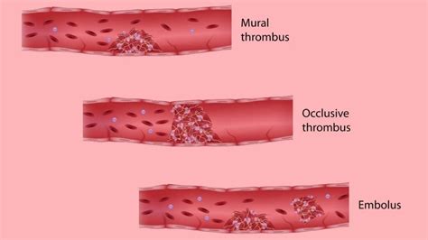 The 5 Best Natural Blood Thinners to Help Prevent Dangerous Clots | 1MD Nutrition™