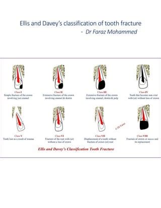 Ellis and davey’s classification of tooth fracture | PDF