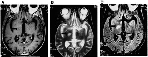 Subthalamic lesion extending to the inferior part of the thalamus on... | Download Scientific ...