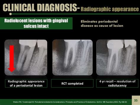 Endodontic Periodontal Relationship, ENDO PERIO LESION