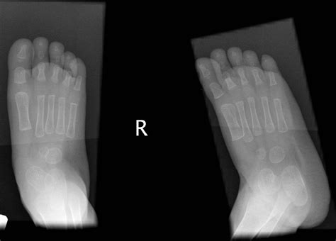 Congenital vertical talus | Image | Radiopaedia.org