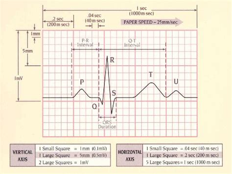 EKG Paper - EKGS Made Simple