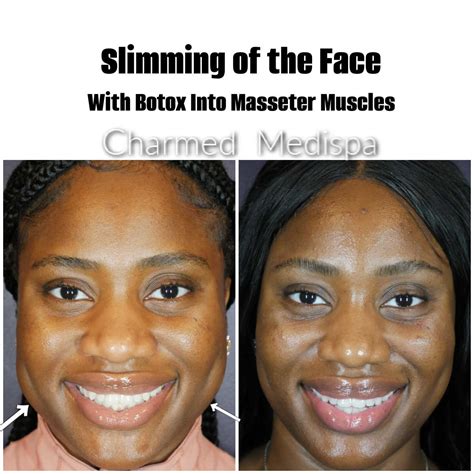 Botox Masseter Muscles To Slim Face And Improve Teeth Grinding – Charmed Medispa