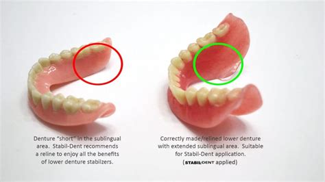 Denture Stabilization And Your Lower Denture-Stabildent