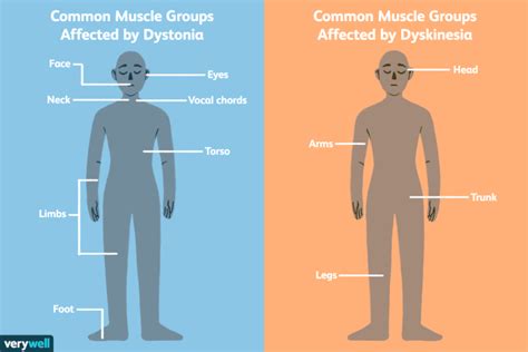 Dyskinesia: Symptoms, Causes, Diagnosis, and Treatment