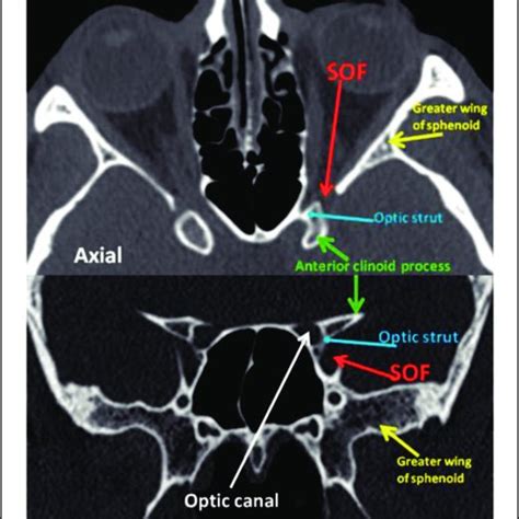 Diagrammatic representation of the right superior orbital fissure with... | Download Scientific ...