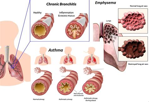 Asthma and Bronchitis are common respiratory conditions - Drvarsha