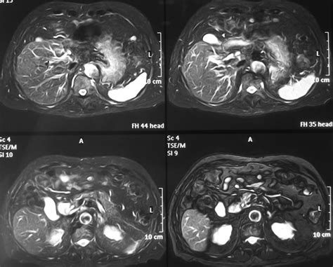 Chest and abdominal MRI with contrast material, showed intestines ...