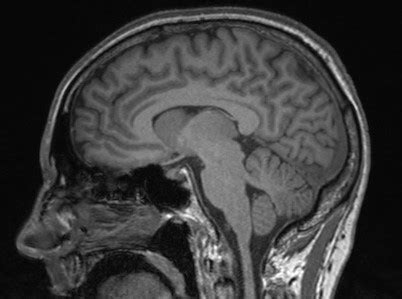 Frontal Lobe Syndrome - astonishingceiyrs