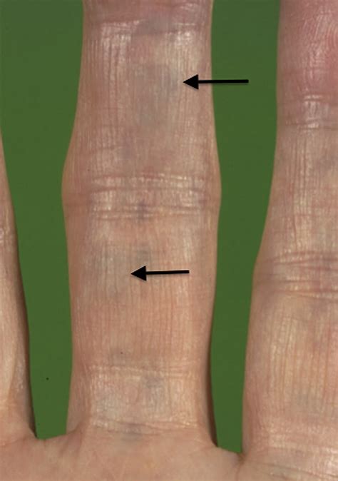 Acute Idiopathic Blue Finger: Case Report - Journal of Hand Surgery