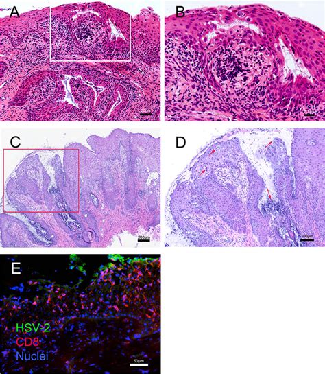 Histopathology and localization of HSV-2 antigen and CD8 T cells in... | Download Scientific Diagram