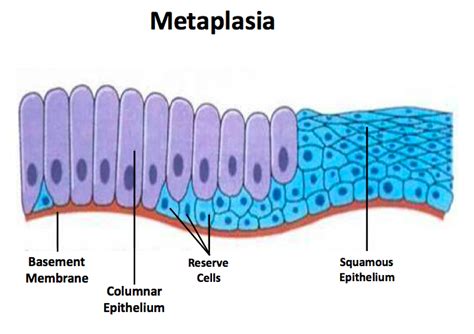 Otorrinoweb - METAPLASIA.