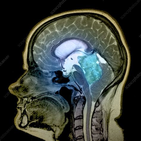 Pineal gland tumour, MRI scan - Stock Image - M134/0891 - Science Photo ...