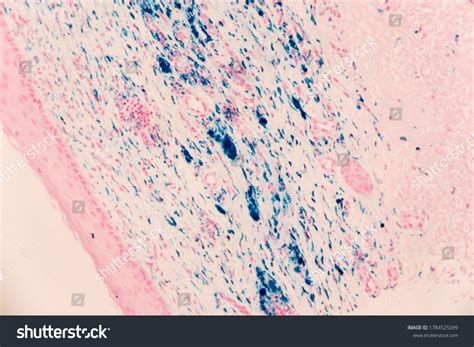 4 Hemosiderin Staining Images, Stock Photos & Vectors | Shutterstock