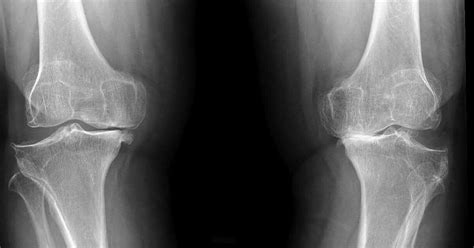 Artrosis de rodilla (Gonartrosis) • Dr. López Capapé