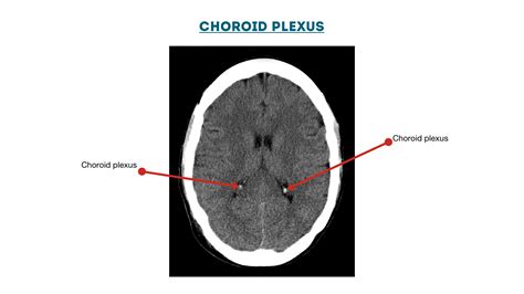 Choroid plexus diagram | Geeky Medics