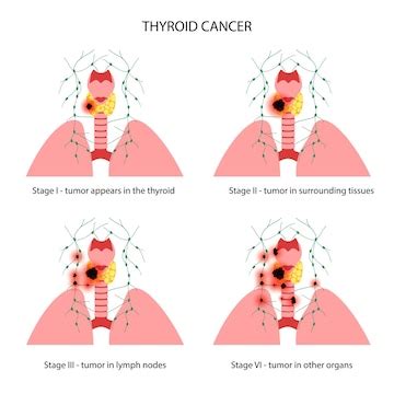 Premium Vector | Thyroid cancer stages