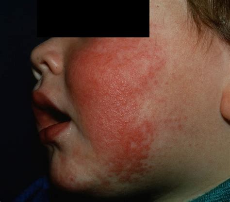 Fifth disease causes, incubation period, rash and fifth disease treatment