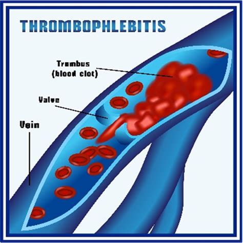 Superficial Thrombophlebitis - New York Vein Treatment Center