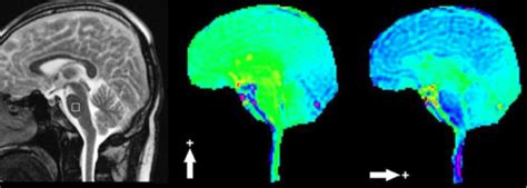 MRI-based Subject-specific Brain Strain and Stress Mapping - niml.org