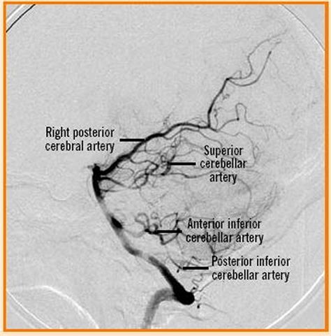 Vertebral Artery Segments, Stenosis and Artery Dissection Symptoms