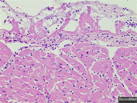 Fibrinous pericarditis