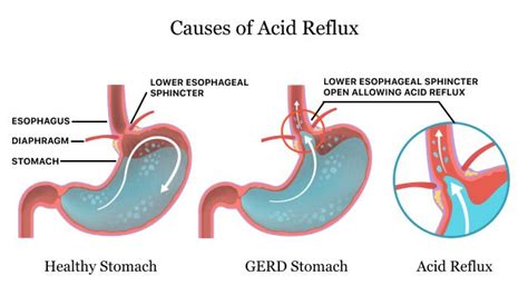 Acid Reflux & Gerd | Symptoms, Causes & Treatment Options