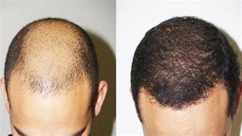 Grow Hair on bald head / Grow New hair on Bald head without fail | Grow hair, New hair, Bald heads