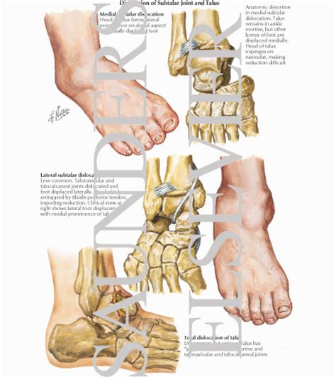 Dislocation of Subtalar Joint and Talus