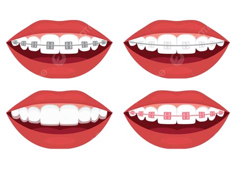 Types Of Braces For Teeth Alignment Metal Ceramic Plastic Ligature And Invisible Vector ...