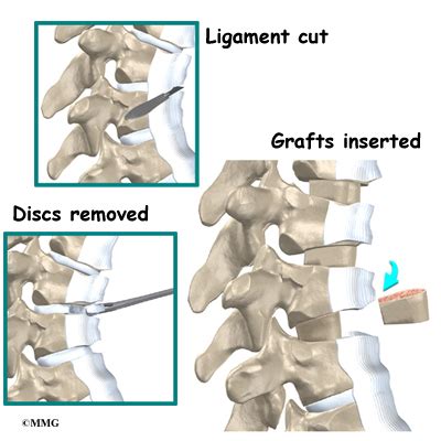 Scheuermann's Disease - Orthogate