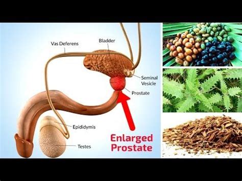 Treatment for Prostate Enlargement - Philadelphia Holistic Clinic - Dr ...