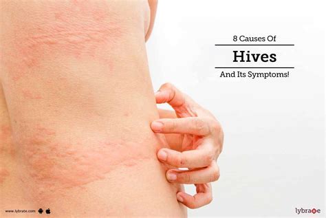 8 Causes Of Hives And Its Symptoms! - By Dr. Archit Aggarwal | Lybrate